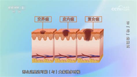 痣變大變凸|痣增大且凸起，是否需要手術切除？